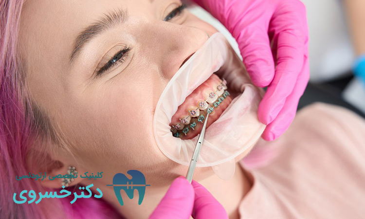 زمان لازم جلسه اول ارتودنسی