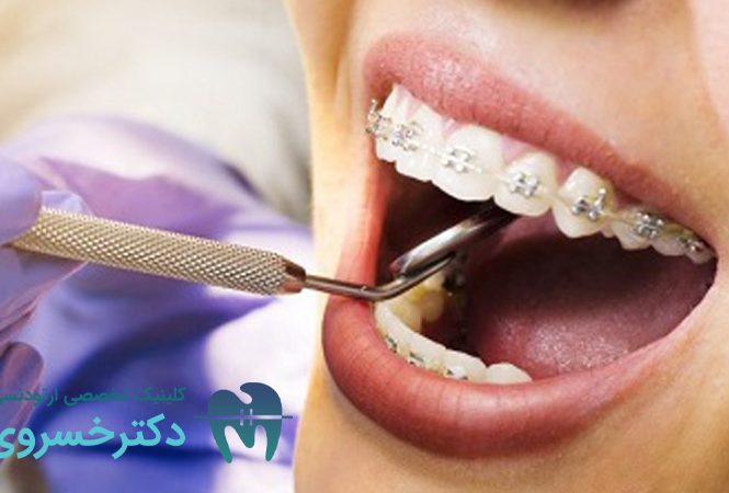 خراب شدن دندان با ارتودنسی