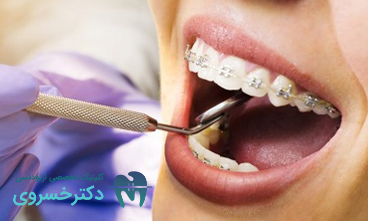 خراب شدن دندان با ارتودنسی