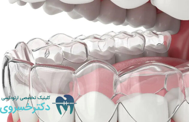 داندن‌هایی که به ارتودنسی نامرئی نیاز دارند ؟