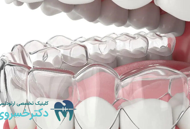 داندن‌هایی که به ارتودنسی نامرئی نیاز دارند ؟