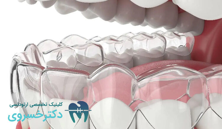 داندن‌هایی که به ارتودنسی نامرئی نیاز دارند ؟