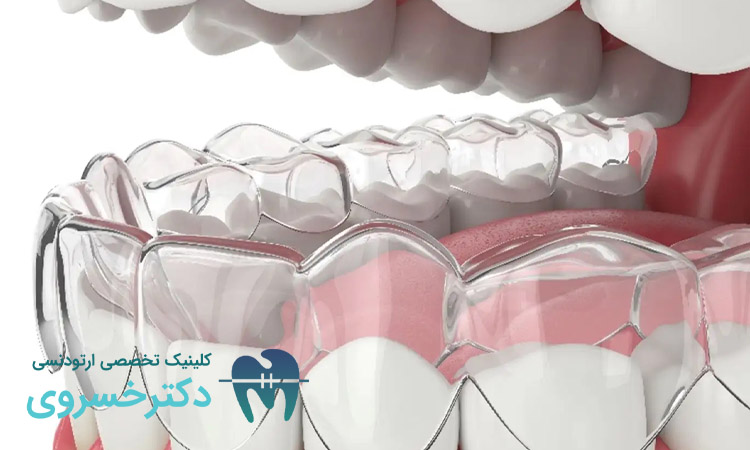 داندن‌هایی که به ارتودنسی نامرئی نیاز دارند ؟