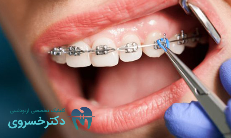 پیشگیری از پوسیدگی دندان در ارتودنسی