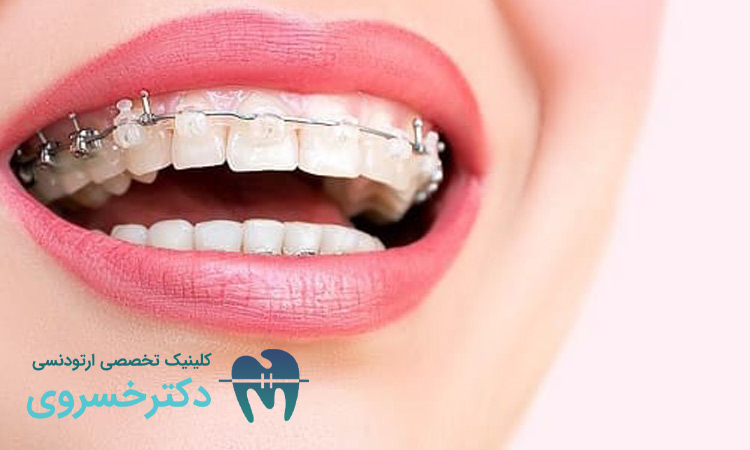 مزایای نگهدارنده متحرک نسبت به نگهدارنده ثابت