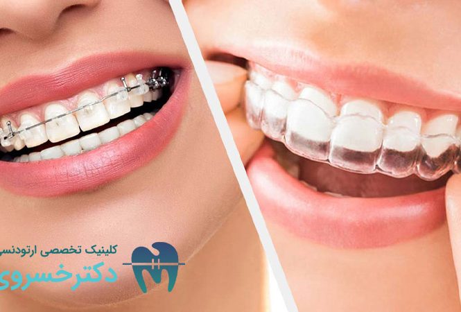 نگهدارنده متحرک بعد از ارتودنسی