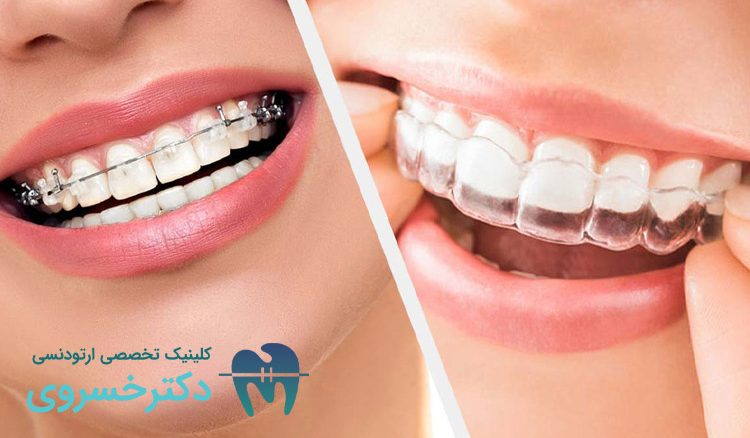 نگهدارنده متحرک بعد از ارتودنسی