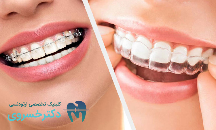 نگهدارنده متحرک بعد از ارتودنسی
