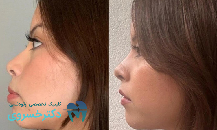 تأثیر تغییرات مکانیکی ارتودنسی بر میکروبیوتا