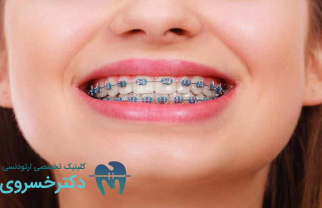 تاثیر ارتودنسی بر سلامت روان