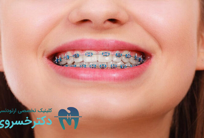 تاثیر ارتودنسی بر سلامت روان
