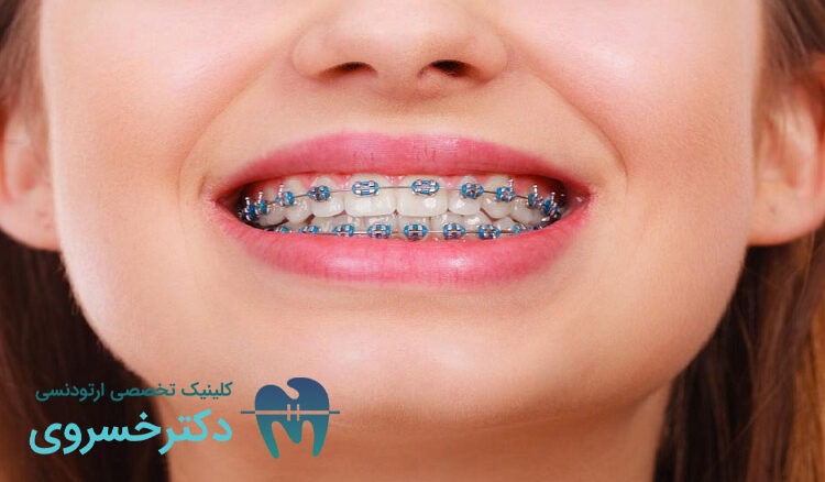 تاثیر ارتودنسی بر سلامت روان