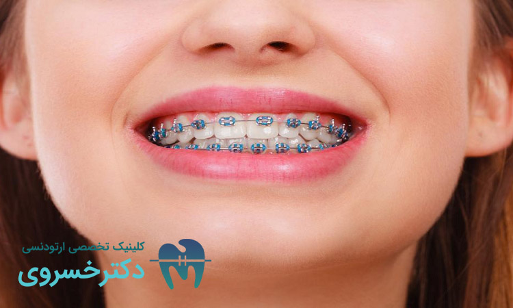 تاثیر ارتودنسی بر سلامت روان
