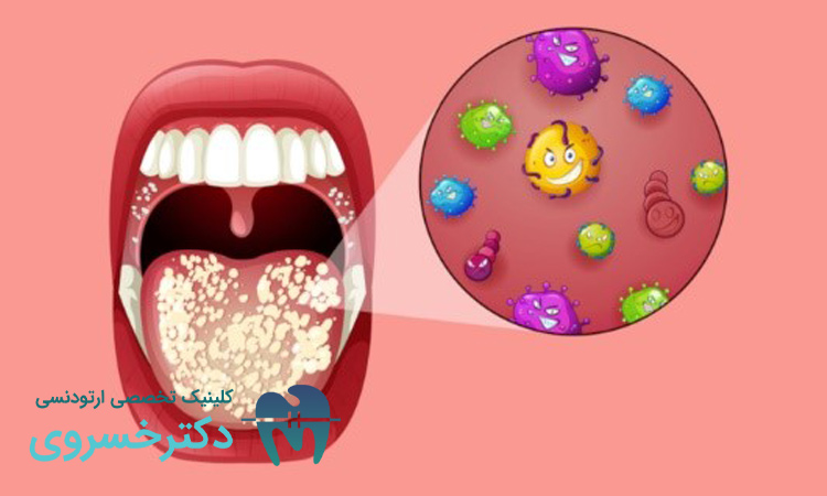 میکروبیوم دهان و سلامت دندان ها