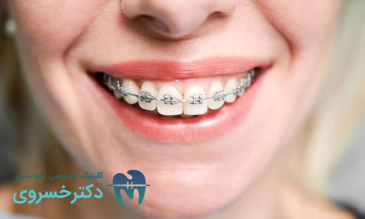 نقش پایدار بودن نتایج ارتودنسی در حفظ اعتماد به نفس بعد از پایان درمان