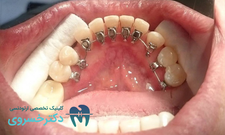 تاثیر بیماری‌های مزمن روی درمان ارتودنسی 