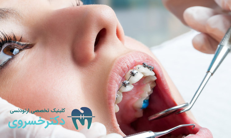 تأثیر اختلال بلع بر درمان ارتودنسی