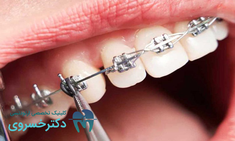 حقایق درباره فواید درمان ارتودنسی