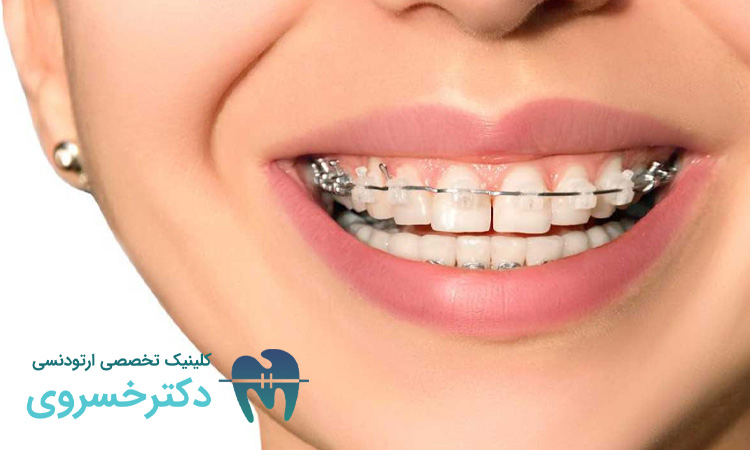 روش های درمانی ارتودنسی مناسب برای بیماران دچار اختلال بلع