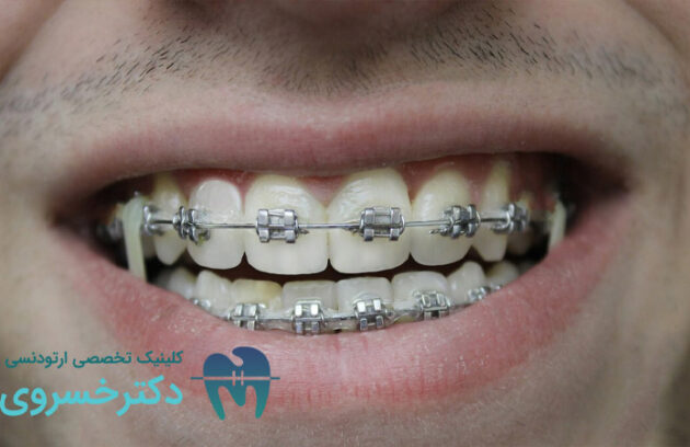 ارتودنسی برای بیماران مبتلا به اختلال بلع