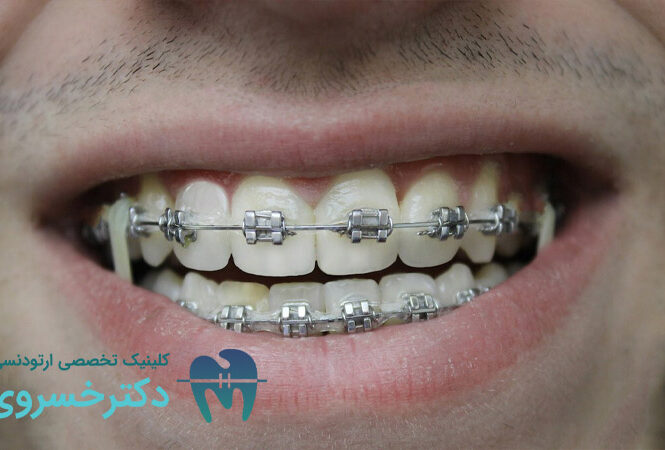 ارتودنسی برای بیماران مبتلا به اختلال بلع