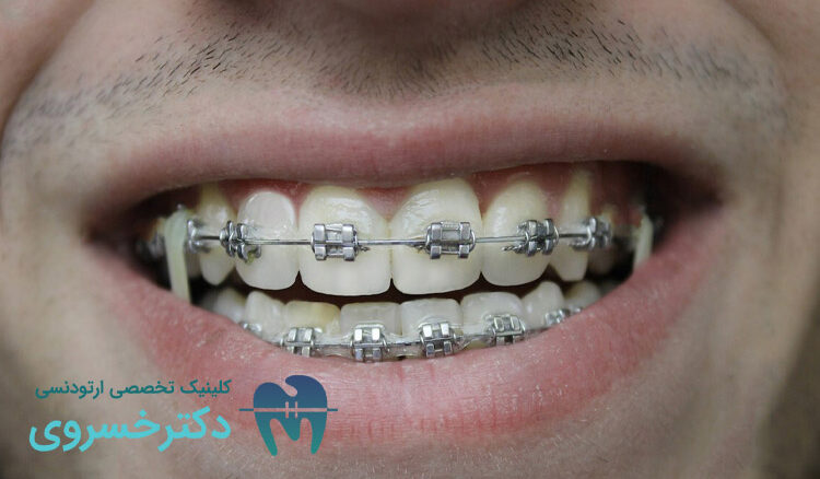 ارتودنسی برای بیماران مبتلا به اختلال بلع