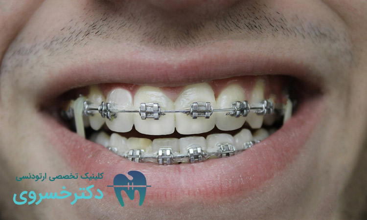 ارتودنسی برای بیماران مبتلا به اختلال بلع
