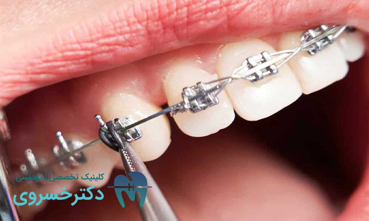 سوالات مهم قبل از نصب براکت ارتودنسی