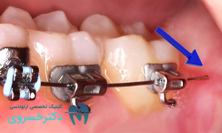 سیم حافظ نیرو برای ارتودنسی زودبازده