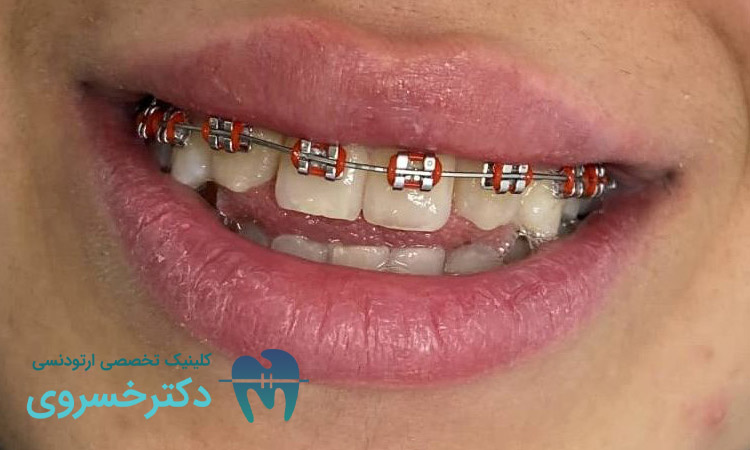 مشکلات محتمل در ارتودنسی بیماران مبتلا به اختلال بلع