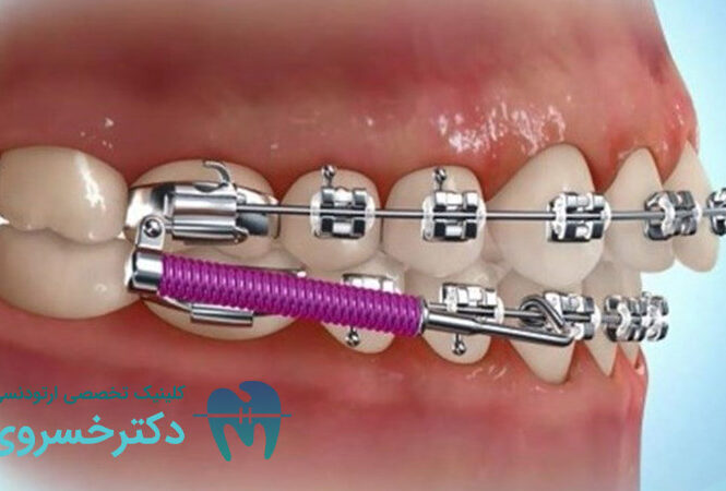 معرفی تکنیک های جدید برای کاهش زمان درمان ارتودنسی