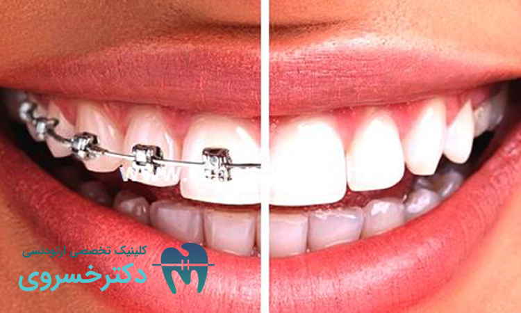 نقش ارتودنسی در بهبود کیفیت زندگی سالمندان