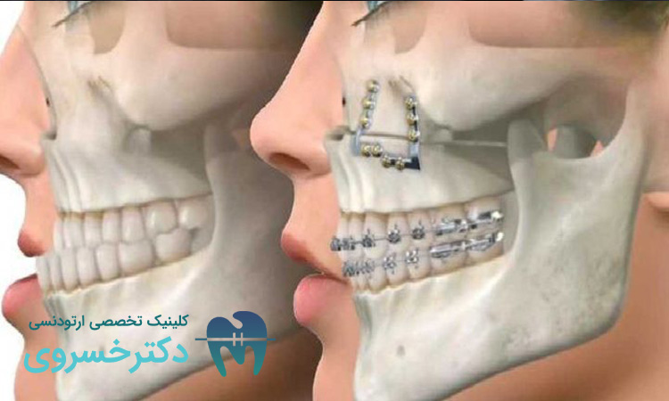 تاثیر ژنها در ساختار استخوانی و رشد فکی