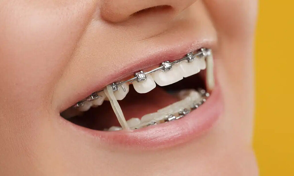 مقاومت و دوام براکت سرامیکی