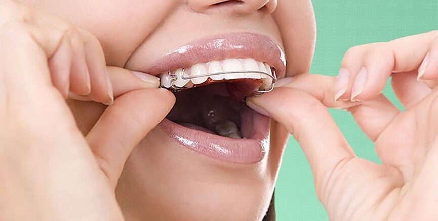 تأثیر ارتودنسی بر گفتار، جویدن و سلامت فک