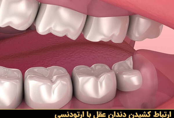دندان عقل و ارتودنسی