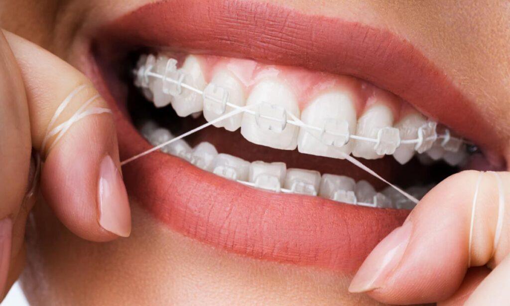 برنامه نظافت روزانه مخصوص بیماران ارتودنسی