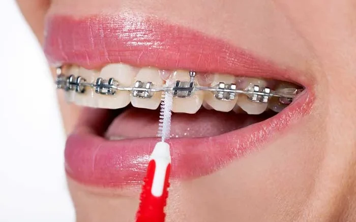 چطور پلاک و سیم ارتودنسی را تمیز کنیم؟