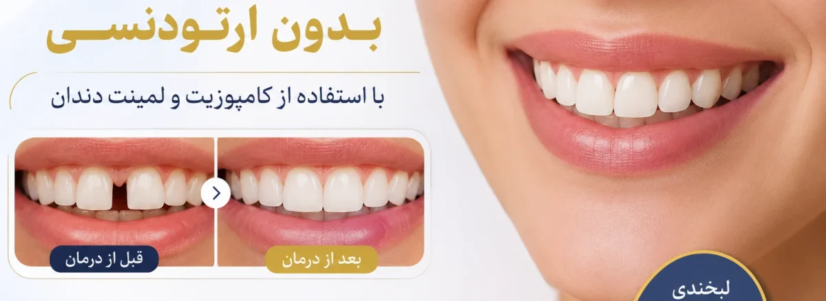 درمان فاصله بین دندان بدون ارتودنسی با استفاده از کامپوزیت و لمینت دندان