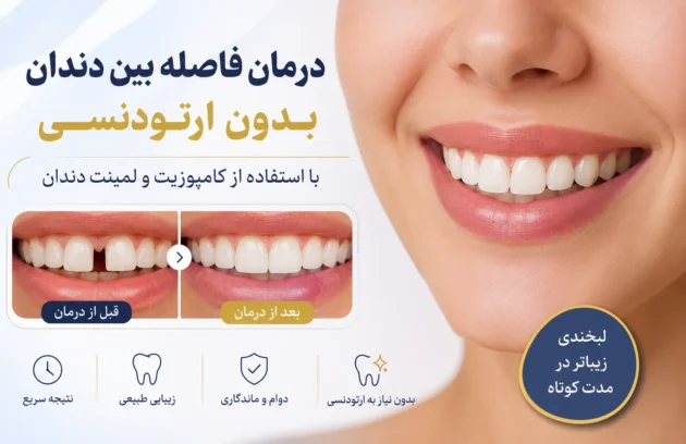 درمان فاصله بین دندان بدون ارتودنسی با استفاده از کامپوزیت و لمینت دندان