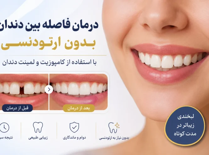 درمان فاصله بین دندان بدون ارتودنسی با استفاده از کامپوزیت و لمینت دندان