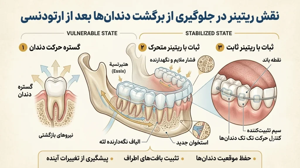 استفاده از ریتینر برای جلوگیری از برگشت دندان بعد از ارتودنسی