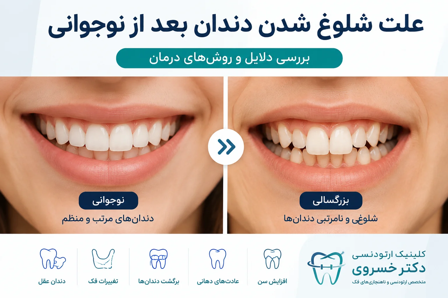 علت شلوغ شدن دندان بعد از نوجوانی و نامرتبی دندان در بزرگسالان