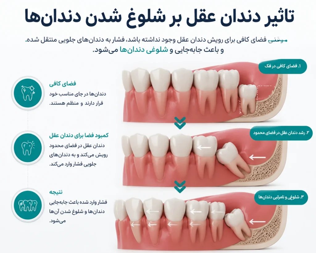 تاثیر دندان عقل نهفته بر شلوغ شدن دندان بعد از نوجوانی