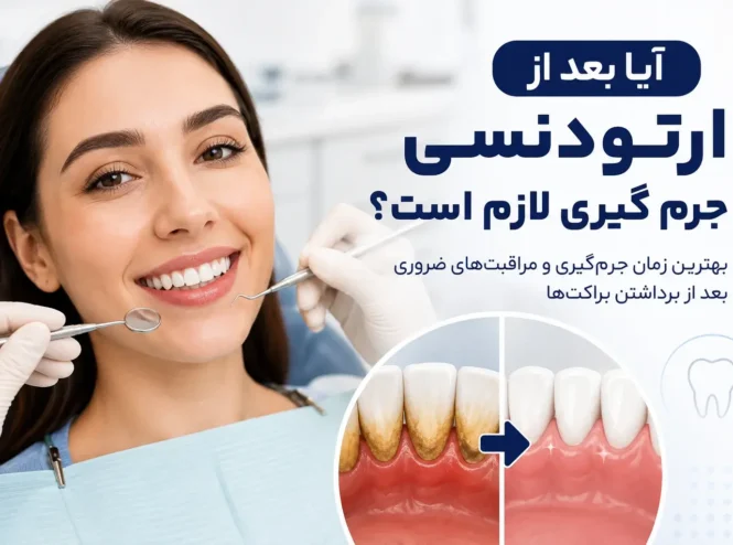 آیا بعد از ارتودنسی جرم گیری لازم است و بهترین زمان انجام آن