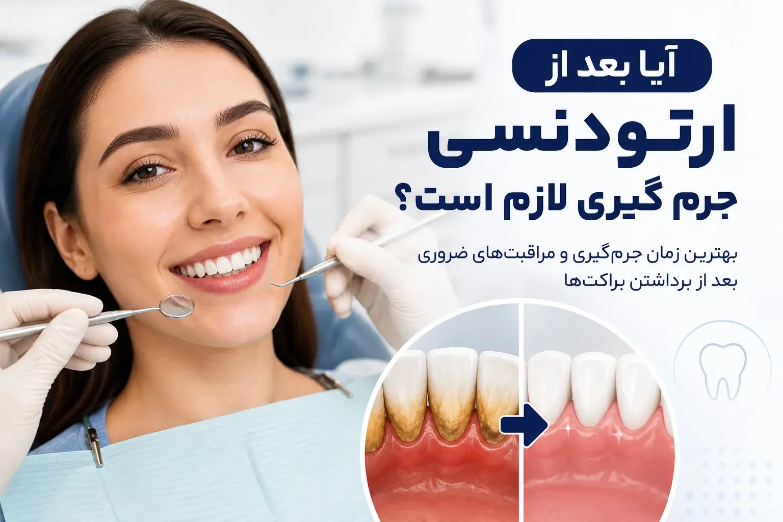 آیا بعد از ارتودنسی جرم گیری لازم است و بهترین زمان انجام آن