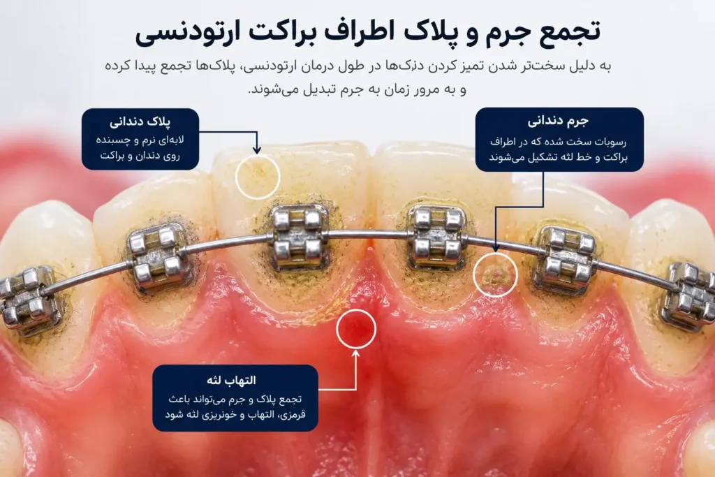 تجمع پلاک و جرم دندان در طول درمان ارتودنسی