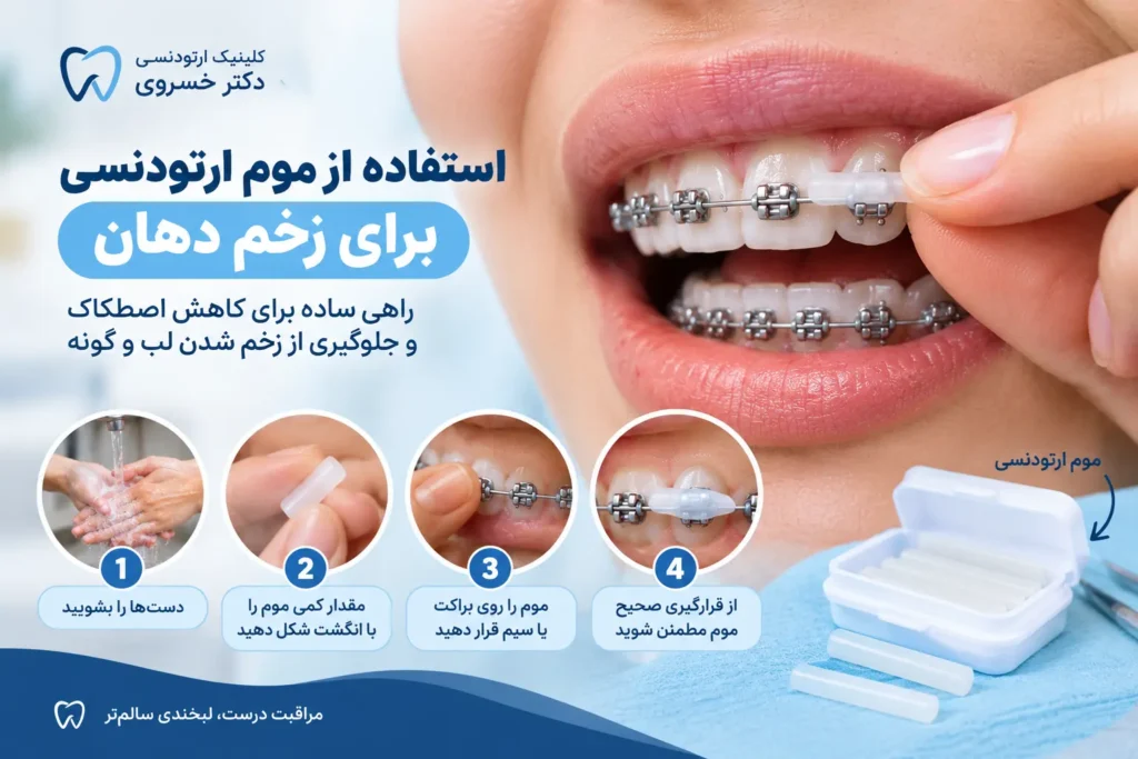 استفاده از موم ارتودنسی برای جلوگیری از زخم لب و گونه