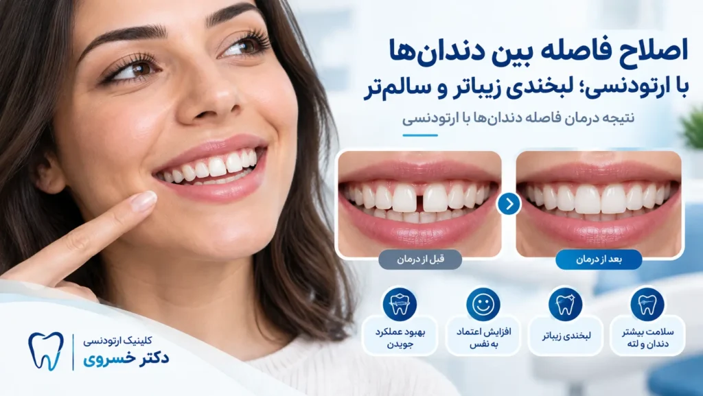اصلاح فاصله بین دندان‌ها با ارتودنسی