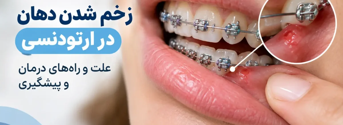 زخم شدن دهان در ارتودنسی و تماس براکت با لب و گونه